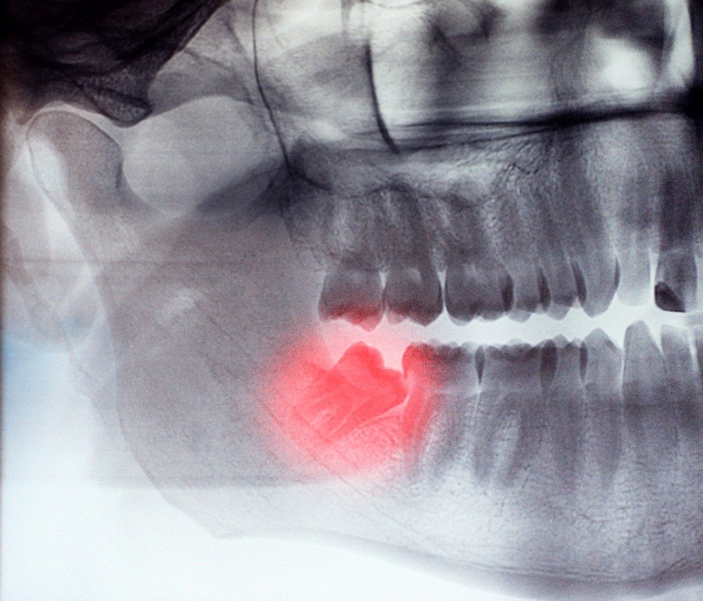 photo showing skew wisdom tooth