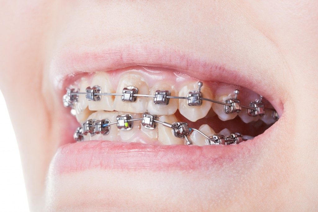 Steel dental brackets close up