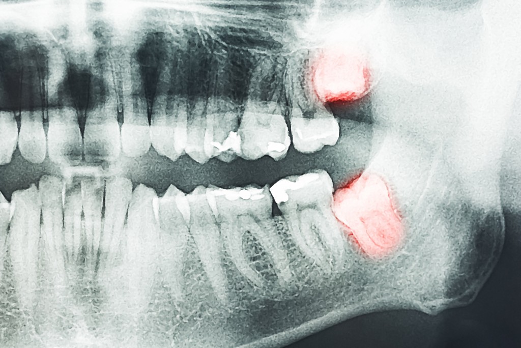 xray of impacted wisdom teeth