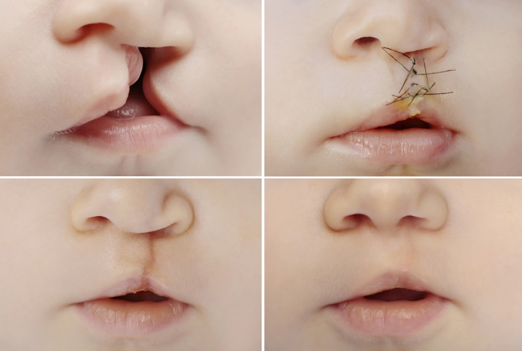 reconstructive surgery of cleft palate