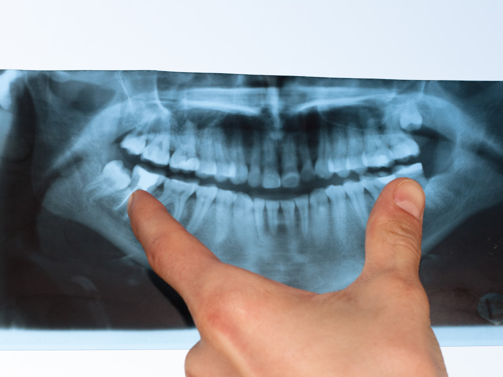 A doctor pointing at an impacted wisdom tooth via x-ray