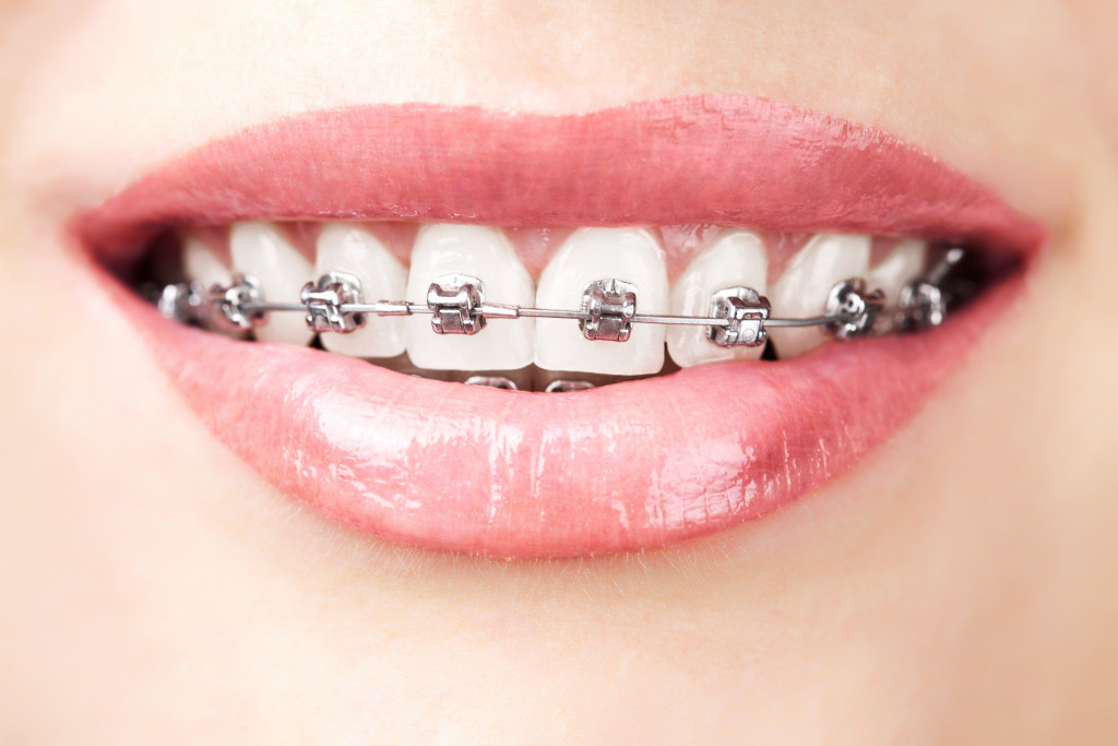 Image of teeth with dental braces